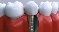 4000元的种植牙可靠吗？牙齿种植效果可以维持多久？